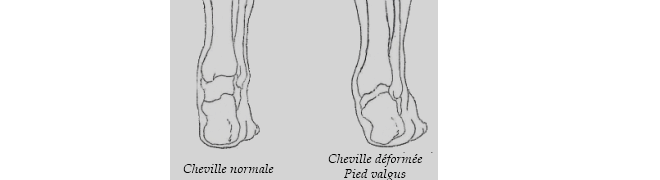 Cheville déformée pied valgus