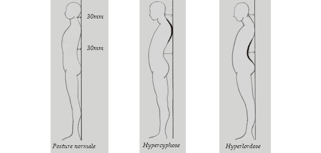 Dépistage de l'hypercyphose et l'hyperlordose